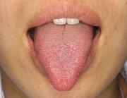 写真:舌を前方に出す