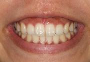 写真:前歯部歯肉