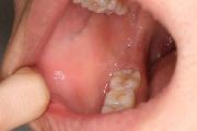 写真:右側頬粘膜