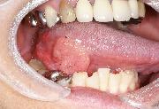 写真:右側舌側面から下面に膨隆を認める