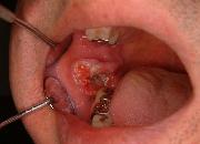 写真:右側頬粘膜に穿下性の病変を認める