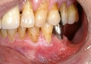 写真:下顎右側の犬歯部から小臼歯部の歯肉に白色病変を認める