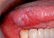 写真:右側舌側面に白変および赤変病変を認める
