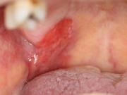 写真:上顎右側軟口蓋から硬口蓋にかけて赤変病変を認める