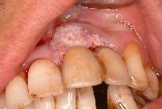 写真:上顎前歯部歯肉に膨隆を認める