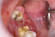 写真:下顎右側大臼歯部に赤変膨隆を認める