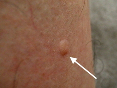 写真:オオハリアリ被害例