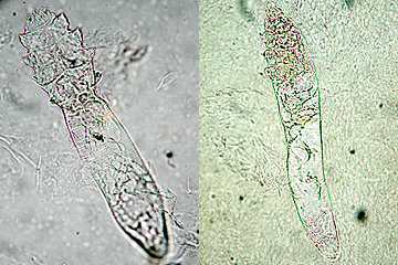 写真:ニキビダニ