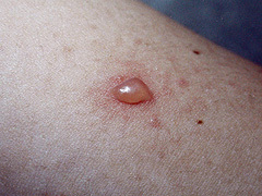 写真:カミキリモドキ類による皮膚炎