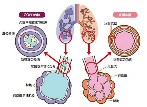 イラスト：COPDの肺と正常な肺